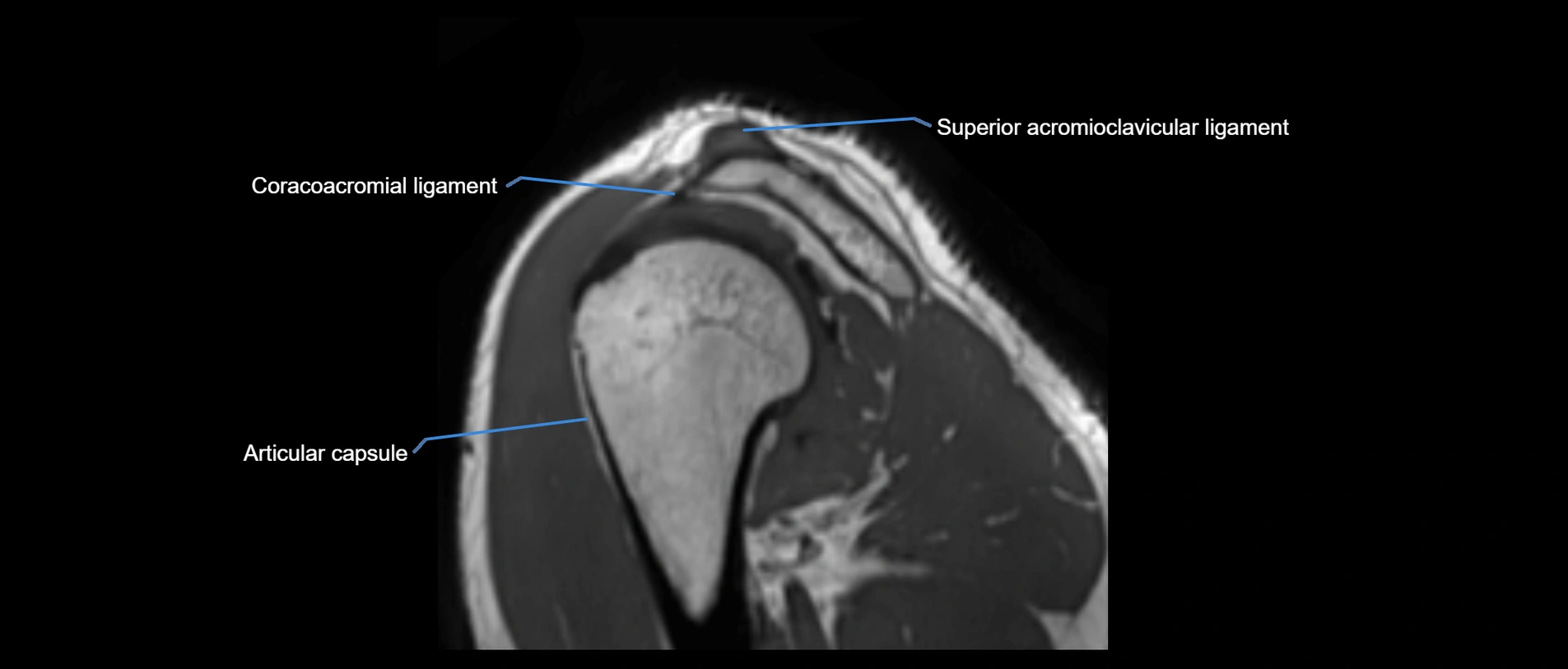 shoulder ligaments sagittal  cross sectional anatomy 3T MRI AI enhanced radiology image -img-00001-00044.webp